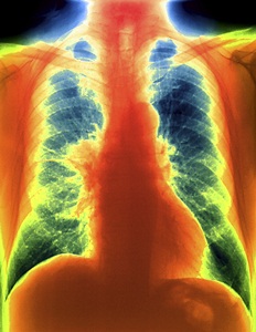 Coloured frontal chest X-ray of a patient with a carcinoid tumour (red, centre left) in their right lung.