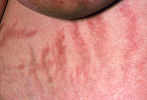 Photo of stretch marks on a woman suffering from Cushing&#39;s syndrome.