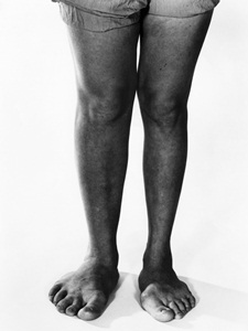 Enlargement of the feet due to pituitary hyperfunction (gigantism).