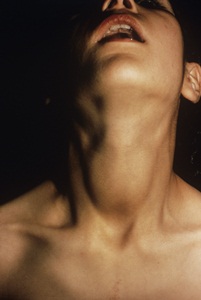 Swollen neck of a patient with goitre.