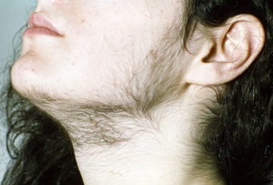 A young woman with hirsutism.