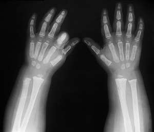 X-ray of the hands of a six year old with hypothyroidism: growth of the left index finger has been stunted.