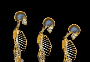 Computer artwork of a human female skeleton degenerating due to osteoporosis. At left is a normal skeleton. The degeneration, seen from left to right over time, is the loss of height and the backwards curvature of the spine.
