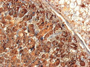 Light micrograph of a section through a phaeochromocytoma tumour of the adrenal gland. At left in the <a  href='/glossary/m#medulla' data-toggle='popover' data-trigger='hover' title='medulla' data-content='1845' >medulla</a>, large tumour cells are seen arranged in cords or small masses marked by chromogranin A (blue); at upper right the normal adrenal cortex is seen.