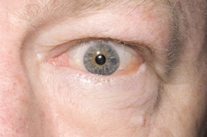 Inflammation of the tissues around the eye of a 58-year-old man with Graves&#39; thyrotoxicosis.