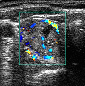Ultrasound scan in transverse section of the thyroid gland of a 73-year-old female patient, showing a hot nodule (increased activity) in one thyroid lobe corresponding to a toxic <a  href='/glossary/a#adenoma' data-toggle='popover' data-trigger='hover' title='adenoma' data-content='1490' >adenoma</a>.