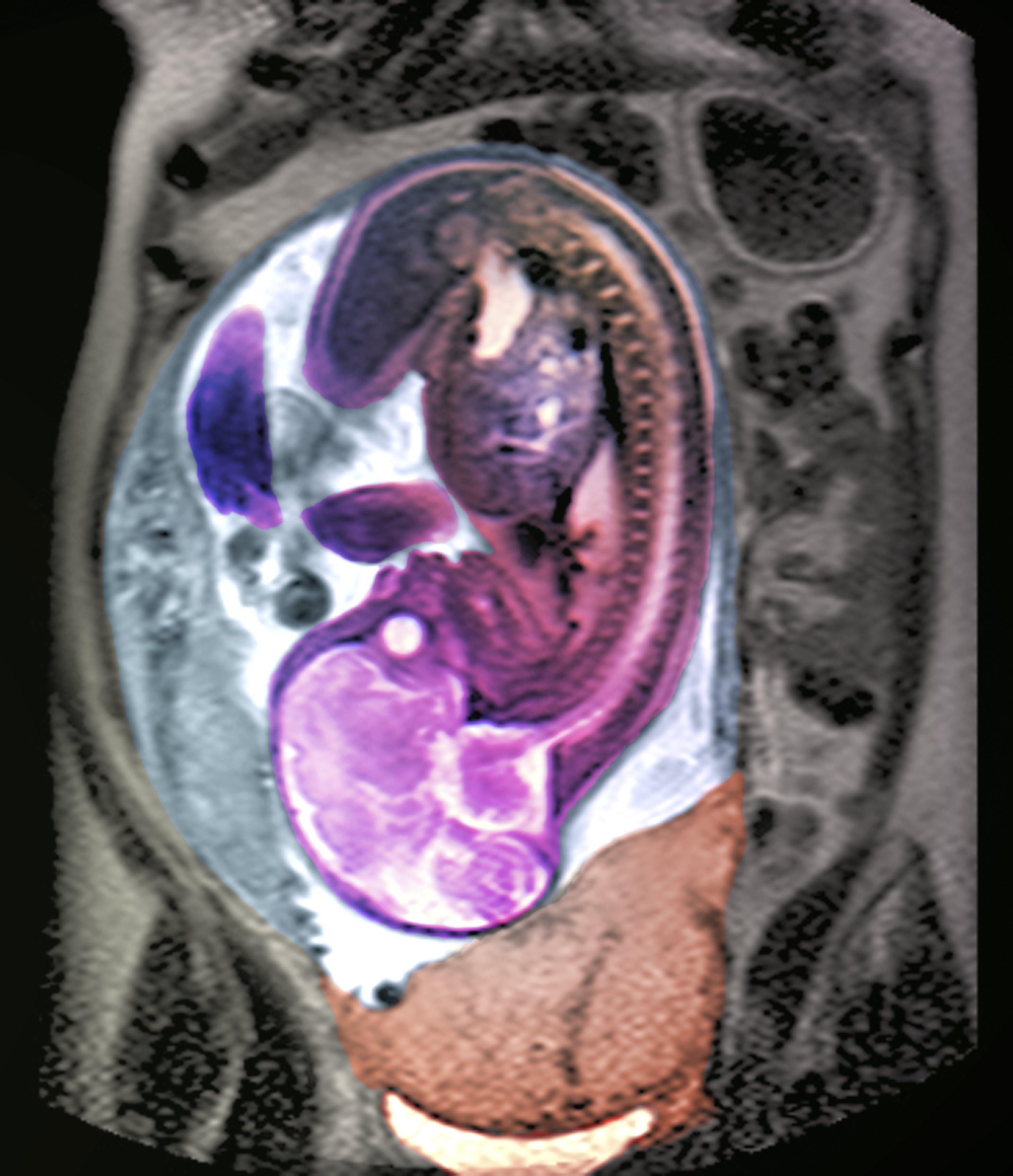 Coloured pelvic magnetic resonance imaging (<a  href='/glossary/m#magnetic-resonance-imaging' data-toggle='popover' data-trigger='hover' title='MRI' data-content='1542' >MRI</a>) scan of a pregnant woman with placenta praevia. The placenta (lower centre) is blocking the <a  href='/glossary/c#cervix' data-toggle='popover' data-trigger='hover' title='cervix' data-content='1511' >cervix</a>, the exit to the womb. The fetus is in &#39;head down&#39; position (the brain can be seen, lower left).