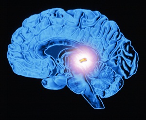 Computer artwork of a sectioned human brain in side view, showing the pineal gland (highlighted). Front of the brain is at left. The pineal gland is situated deep within the brain, just below the back of the corpus callosum.