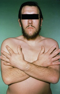 Image showing a gentleman with some features of acromegaly – prominent ridges above the eyes and large spade-like hands.