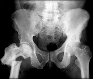 Frontal X-ray of a human pelvis and hips with a severe fracture of the right femur near the hip, caused by Paget&#39;s disease, which weakens bones and predisposes them to fracture.