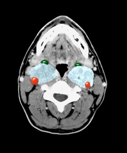 Cross sectional contrast enhanced CT image showing masses (paragangliomas) in both sides of the neck.