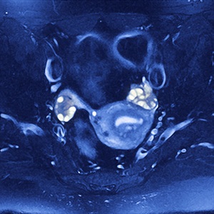 MRI scan of a female patient with polycystic ovary syndrome. Multiple cysts (white) have formed in the ovaries (centre left and right).