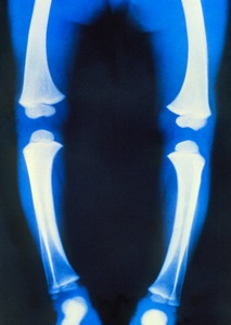 Coloured X-ray of the weakened bones and bowed legs of a child suffering from rickets.