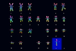 Light micrograph of the chromosomes (karyotype) of a female with Turner syndrome. Turner syndrome is caused by the presence of only one X chromosome (at bottom right, blue highlight).