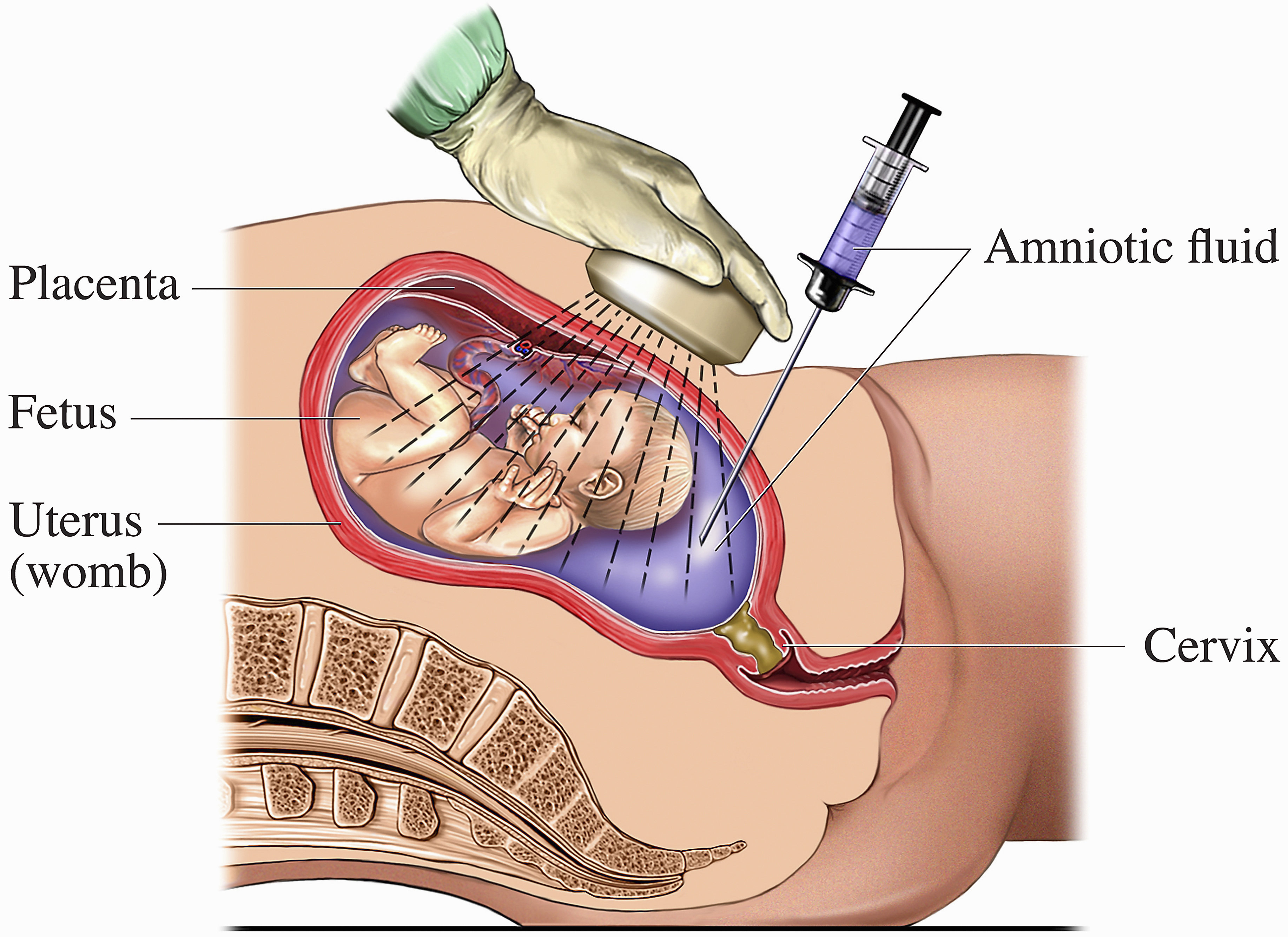 A medical drawing to show the process of <a  href='/glossary/a#amniocentesis' data-toggle='popover' data-trigger='hover' title='amniocentesis' data-content='1495' >amniocentesis</a>, which can be carried out during pregnancy. A fine needed is used to take a sample of amniotic fluid from the mother&#39;s uterus (womb), which is then analysed to determine the karyotype (chromosome arrangement) of the fetus..