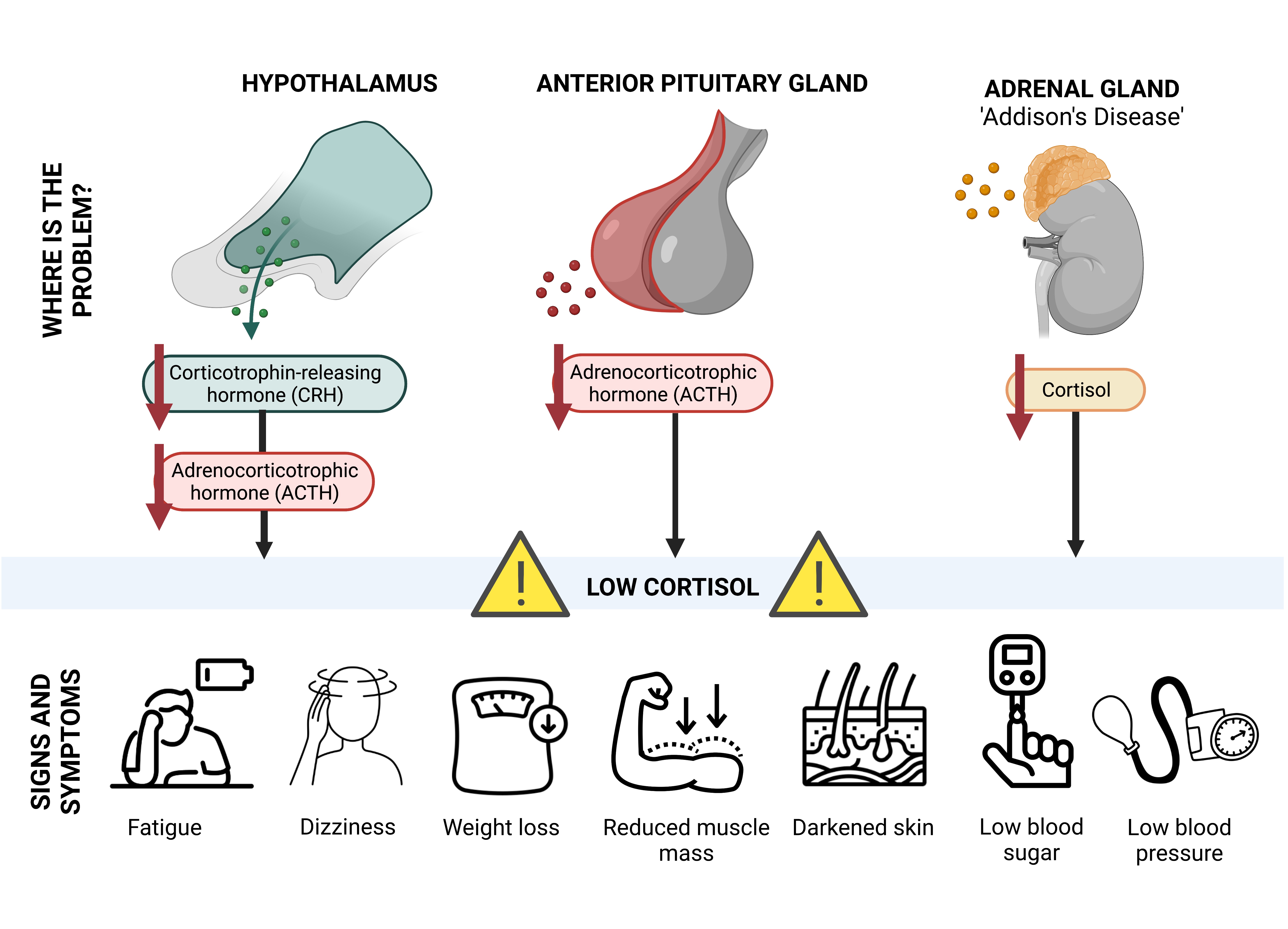 Too little cortisol may be due to a problem in the hypothalamus, anterior pituitary gland or the adrenal glands also known as Addison’s disease. Signs and symptoms of low cortisol may include fatigue, dizziness, weight loss, reduced muscle mass / muscle weakness, darkening of regions of the skin, low blood sugar and low blood pressure.