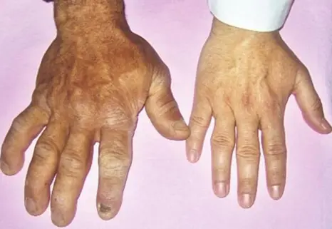 Acromegaly4