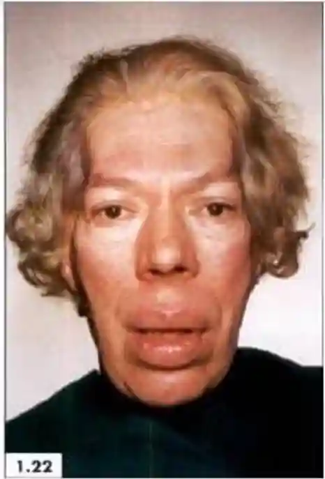 Acromegaly2