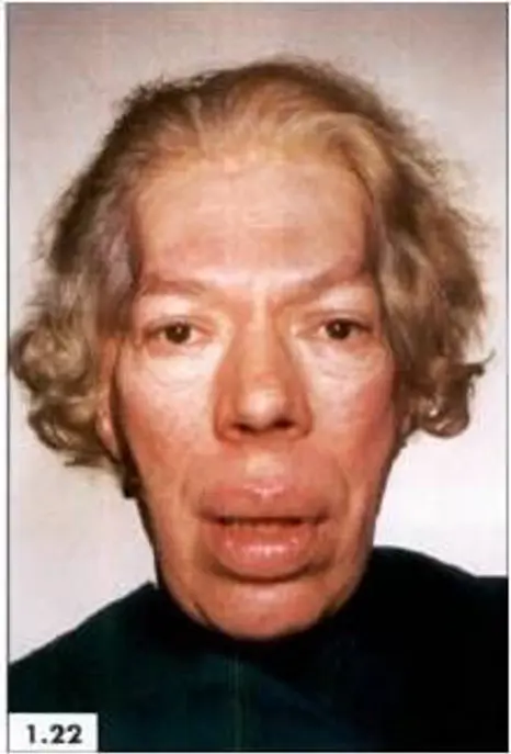 Acromegaly2