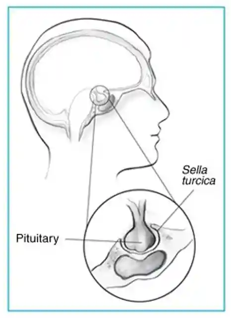 Acromegaly1