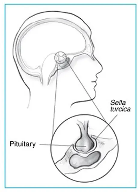 Acromegaly1